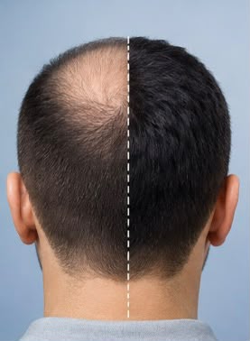 زراعة الشعر واللحية